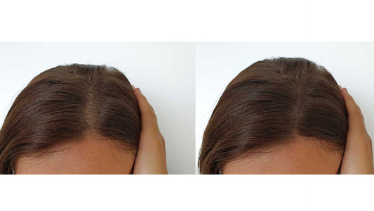 Biotin hair growth before and after pictures- real or hype?